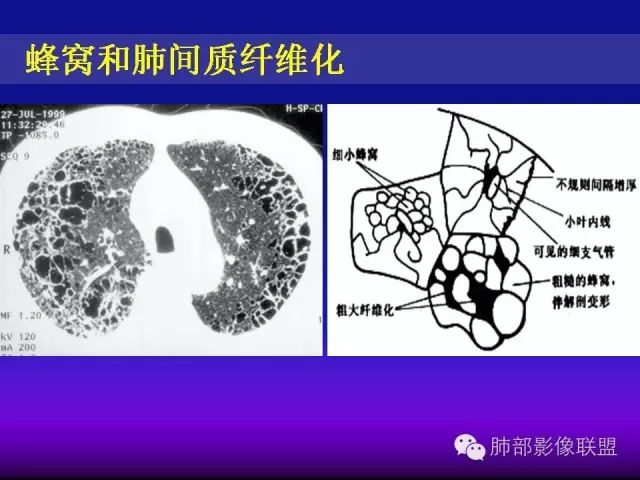影像PPT - 【PPT 】弥漫性低密度肺疾病-51