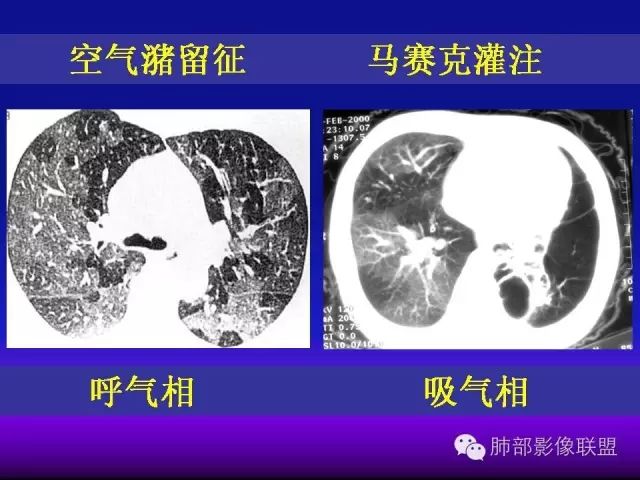 影像PPT - 【PPT 】弥漫性低密度肺疾病-49