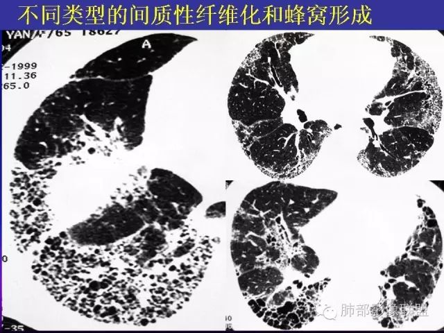 影像PPT - 【PPT 】弥漫性低密度肺疾病-53