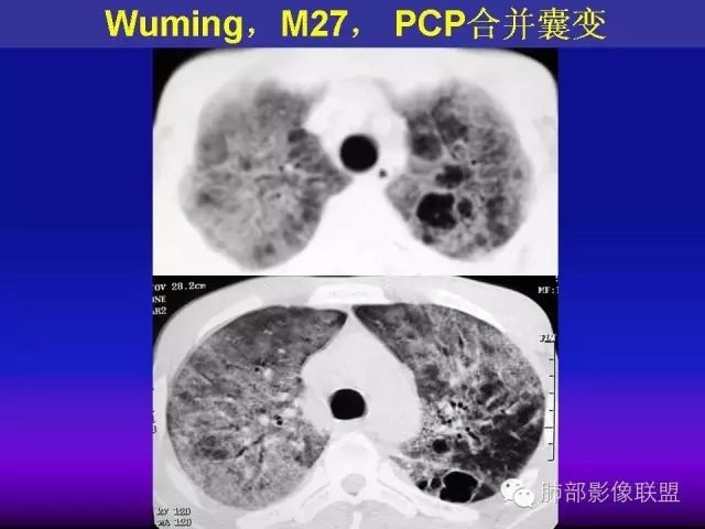 影像PPT - 【PPT 】弥漫性低密度肺疾病-56