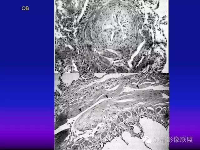 影像PPT - 【PPT 】弥漫性低密度肺疾病-42