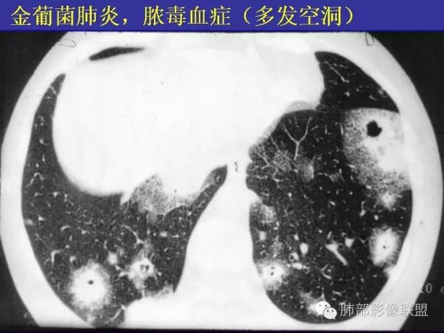 影像PPT - 【PPT 】弥漫性低密度肺疾病-55