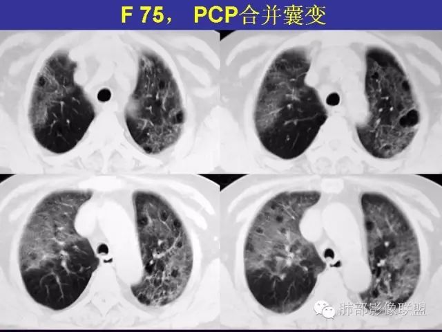 影像PPT - 【PPT 】弥漫性低密度肺疾病-57