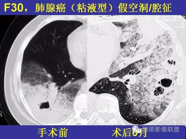 影像PPT - 【PPT 】弥漫性低密度肺疾病-61