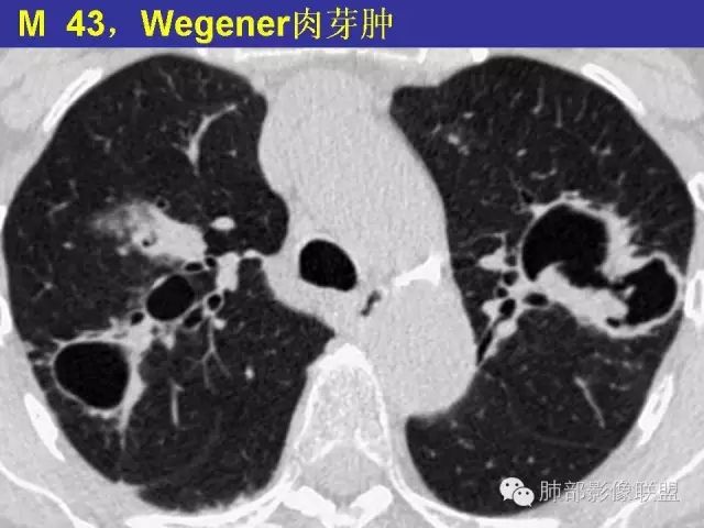 影像PPT - 【PPT 】弥漫性低密度肺疾病-58