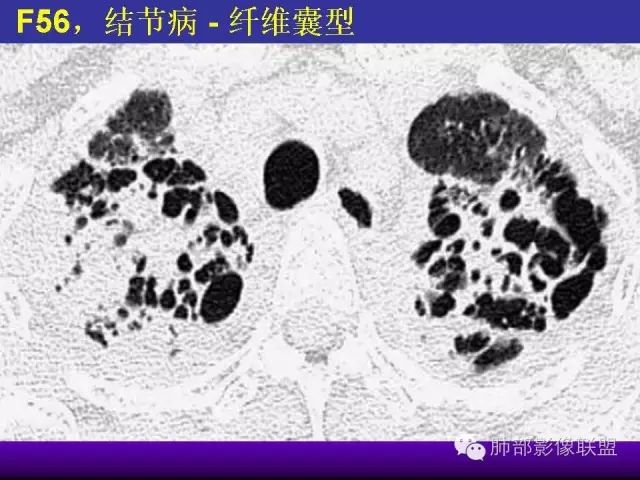 影像PPT - 【PPT 】弥漫性低密度肺疾病-60
