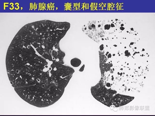 影像PPT - 【PPT 】弥漫性低密度肺疾病-62