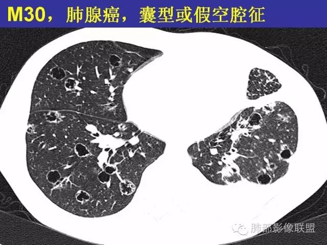 影像PPT - 【PPT 】弥漫性低密度肺疾病-63