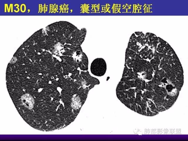 影像PPT - 【PPT 】弥漫性低密度肺疾病-64