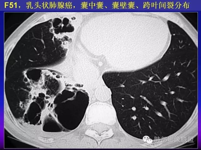 影像PPT - 【PPT 】弥漫性低密度肺疾病-65