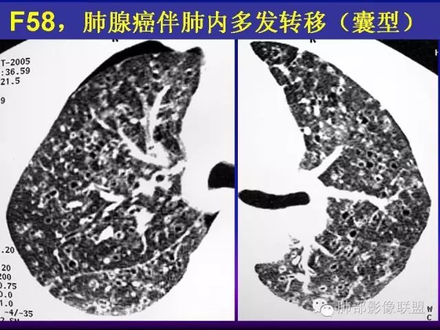 影像PPT - 【PPT 】弥漫性低密度肺疾病-66