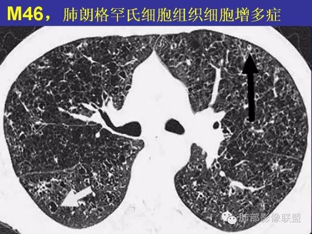 影像PPT - 【PPT 】弥漫性低密度肺疾病-69