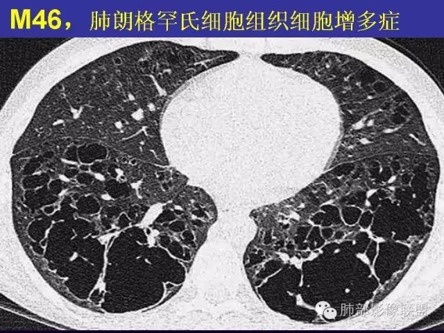 影像PPT - 【PPT 】弥漫性低密度肺疾病-70