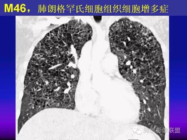 影像PPT - 【PPT 】弥漫性低密度肺疾病-71