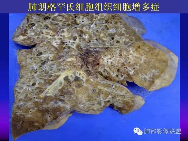 影像PPT - 【PPT 】弥漫性低密度肺疾病-72
