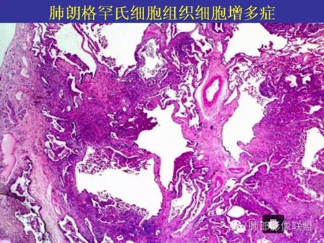 影像PPT - 【PPT 】弥漫性低密度肺疾病-73