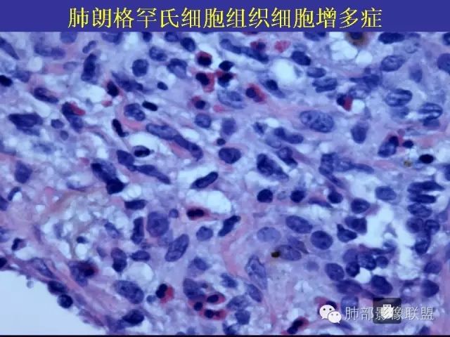 影像PPT - 【PPT 】弥漫性低密度肺疾病-74