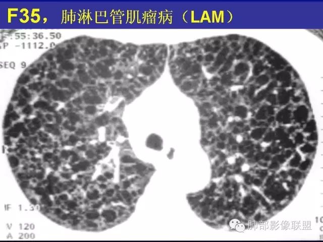 影像PPT - 【PPT 】弥漫性低密度肺疾病-77