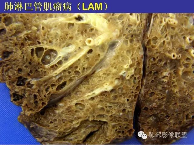 影像PPT - 【PPT 】弥漫性低密度肺疾病-79