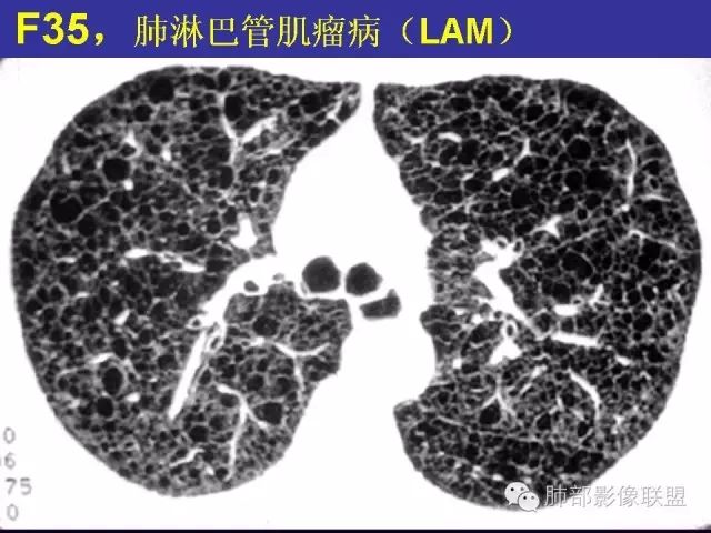 影像PPT - 【PPT 】弥漫性低密度肺疾病-78