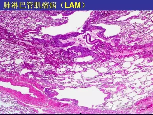 影像PPT - 【PPT 】弥漫性低密度肺疾病-80