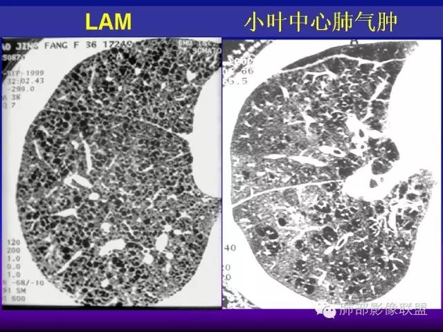 影像PPT - 【PPT 】弥漫性低密度肺疾病-82
