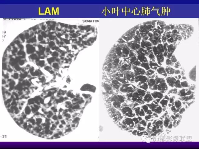 影像PPT - 【PPT 】弥漫性低密度肺疾病-83