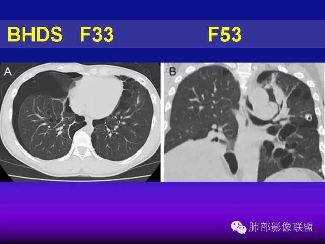 影像PPT - 【PPT 】弥漫性低密度肺疾病-86