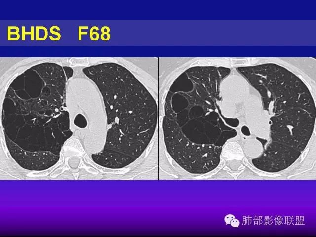 影像PPT - 【PPT 】弥漫性低密度肺疾病-85