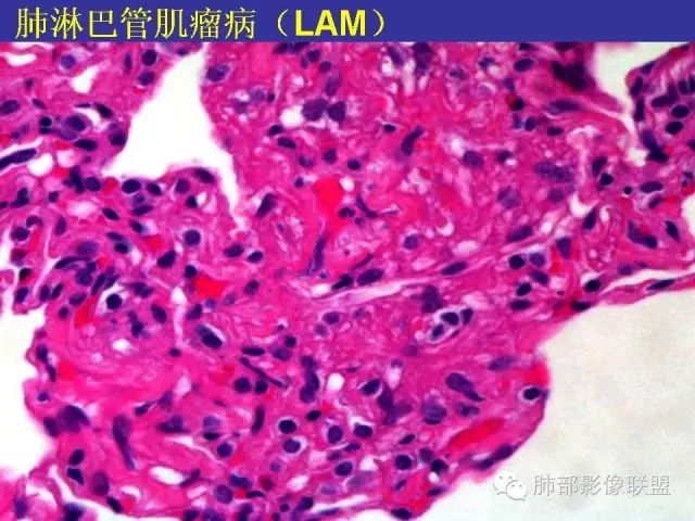 影像PPT - 【PPT 】弥漫性低密度肺疾病-81