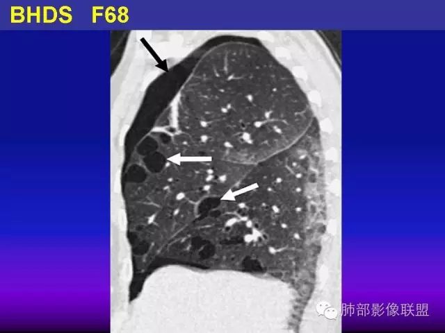 影像PPT - 【PPT 】弥漫性低密度肺疾病-87