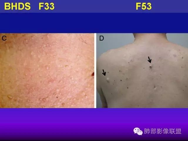 影像PPT - 【PPT 】弥漫性低密度肺疾病-88