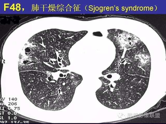 影像PPT - 【PPT 】弥漫性低密度肺疾病-92