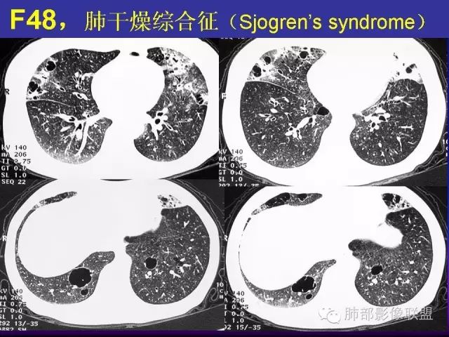 影像PPT - 【PPT 】弥漫性低密度肺疾病-91