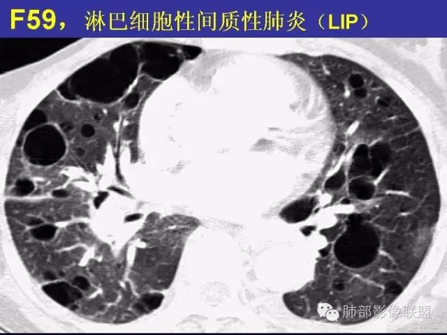 影像PPT - 【PPT 】弥漫性低密度肺疾病-93