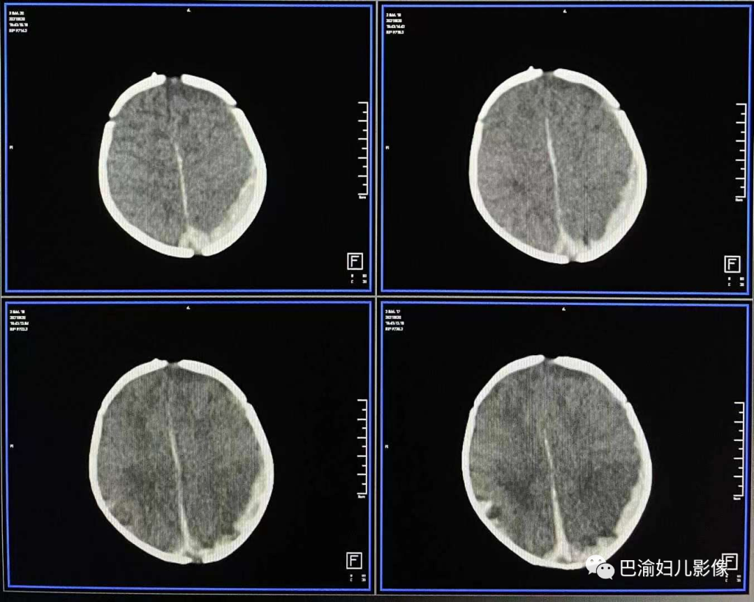 影像PPT - 晚发性维生素K缺乏症的影像诊断-1 影像PPT - 晚发性维生素K缺乏症的影像诊断-1