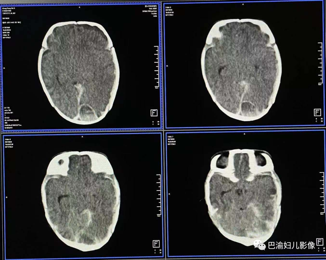 影像PPT - 晚发性维生素K缺乏症的影像诊断-2 影像PPT - 晚发性维生素K缺乏症的影像诊断-2