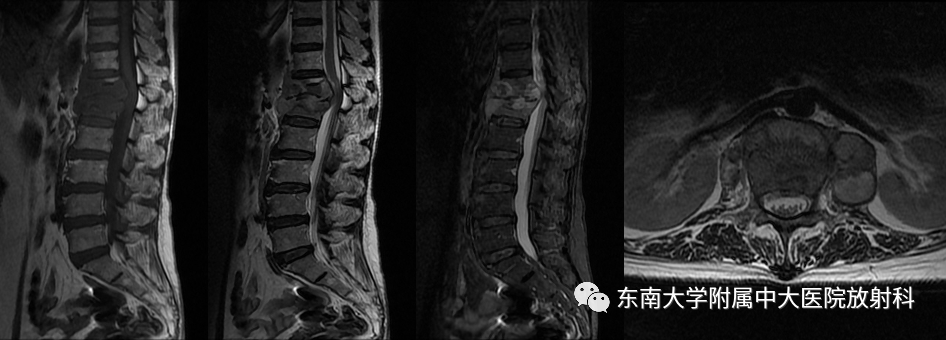影像PPT - 【PPT】脊柱结核的影像诊断-2 影像PPT - 【PPT】脊柱结核的影像诊断-2
