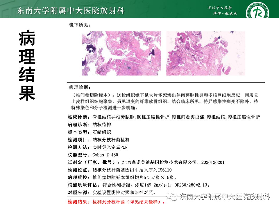 影像PPT - 【PPT】脊柱结核的影像诊断-7 影像PPT - 【PPT】脊柱结核的影像诊断-7
