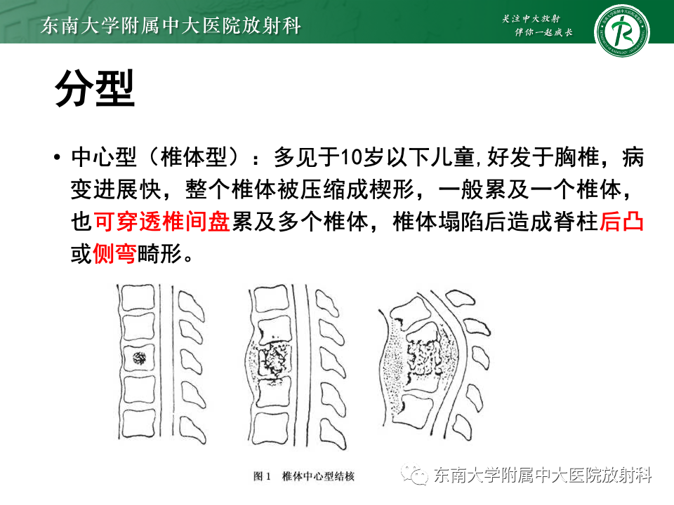 影像PPT - 【PPT】脊柱结核的影像诊断-11 影像PPT - 【PPT】脊柱结核的影像诊断-11