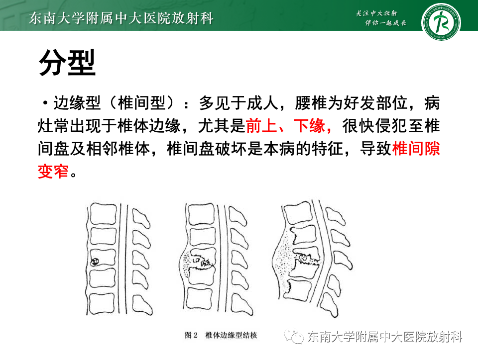 影像PPT - 【PPT】脊柱结核的影像诊断-12 影像PPT - 【PPT】脊柱结核的影像诊断-12