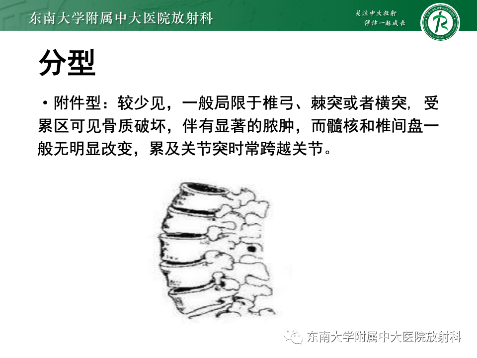 影像PPT - 【PPT】脊柱结核的影像诊断-14 影像PPT - 【PPT】脊柱结核的影像诊断-14