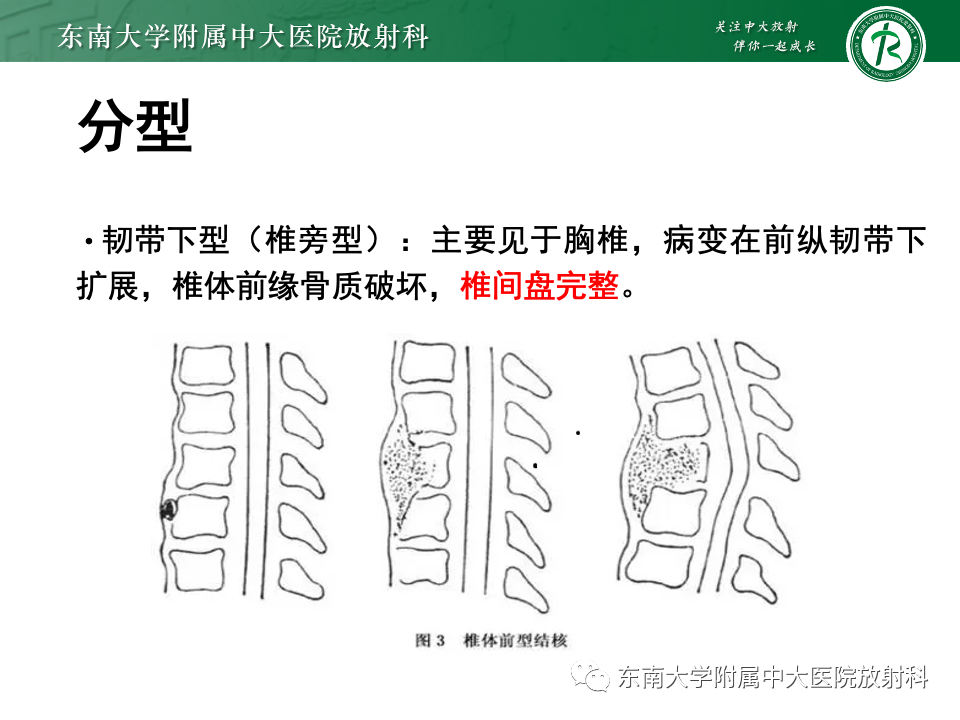 影像PPT - 【PPT】脊柱结核的影像诊断-13 影像PPT - 【PPT】脊柱结核的影像诊断-13