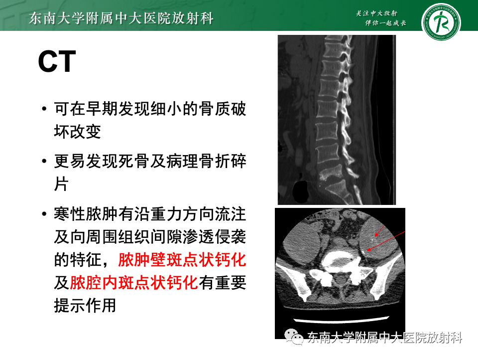 影像PPT - 【PPT】脊柱结核的影像诊断-20 影像PPT - 【PPT】脊柱结核的影像诊断-20