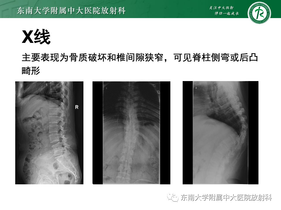 影像PPT - 【PPT】脊柱结核的影像诊断-19 影像PPT - 【PPT】脊柱结核的影像诊断-19