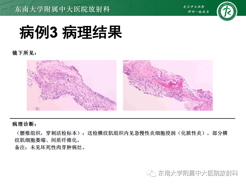 影像PPT - 【PPT】脊柱结核的影像诊断-25 影像PPT - 【PPT】脊柱结核的影像诊断-25