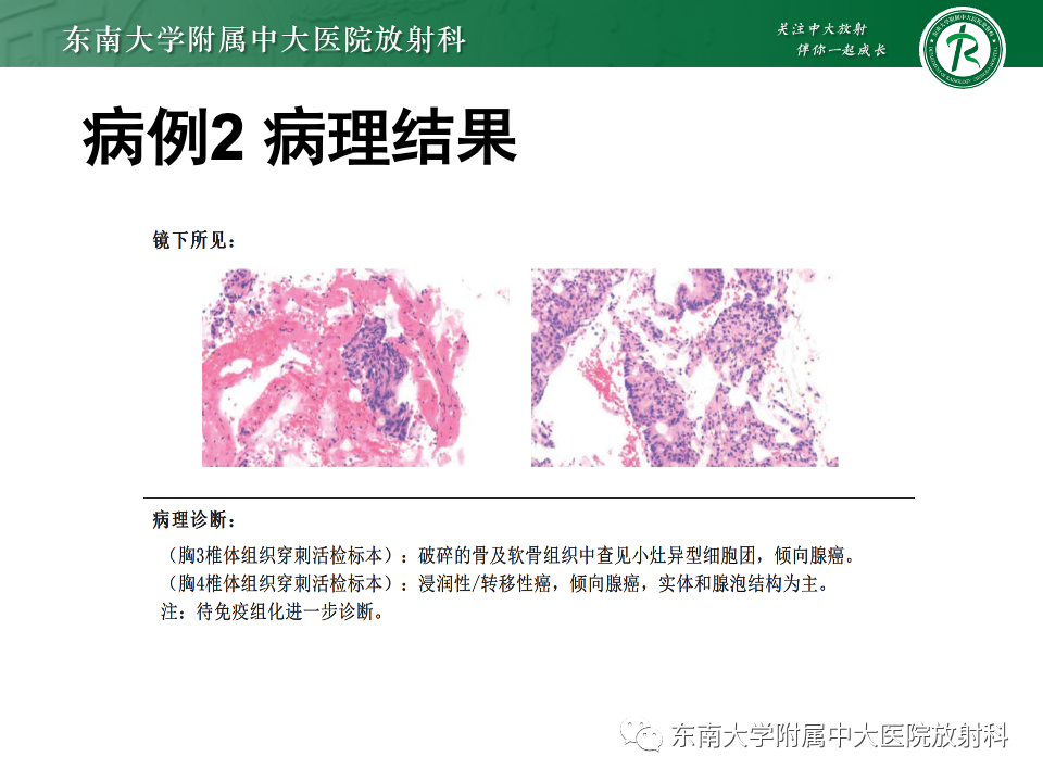 影像PPT - 【PPT】脊柱结核的影像诊断-23 影像PPT - 【PPT】脊柱结核的影像诊断-23