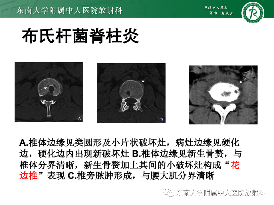 影像PPT - 【PPT】脊柱结核的影像诊断-30 影像PPT - 【PPT】脊柱结核的影像诊断-30
