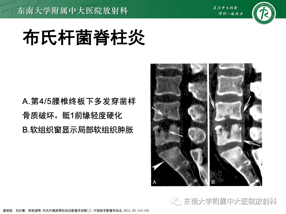 影像PPT - 【PPT】脊柱结核的影像诊断-29 影像PPT - 【PPT】脊柱结核的影像诊断-29