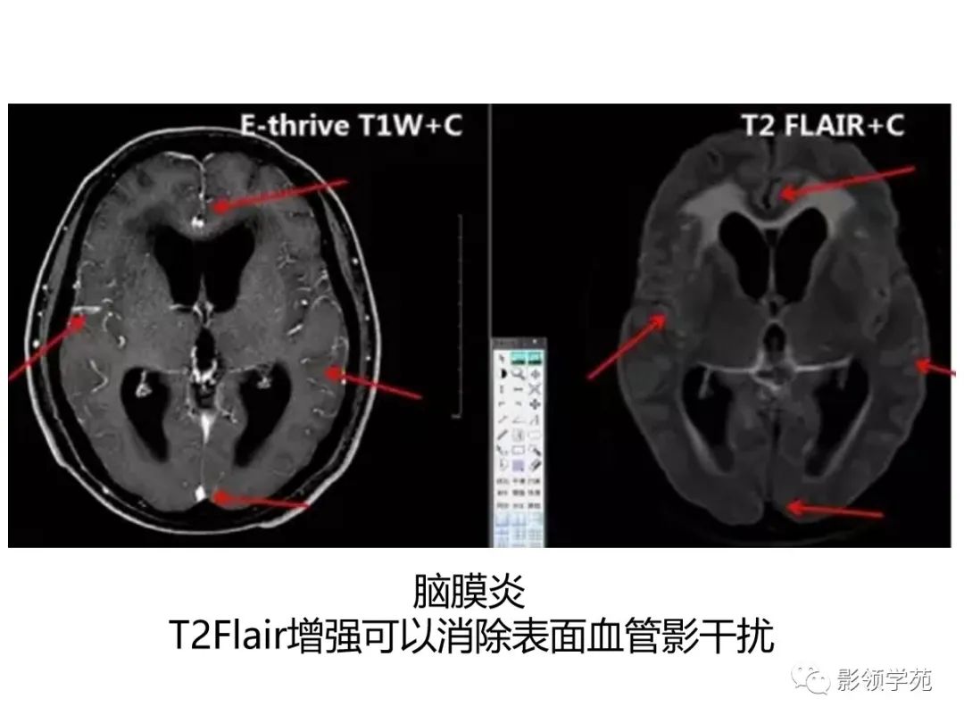 影像PPT - 【PPT】头颅T2-Flair增强扫描的意义及临床应用-17 影像PPT - 【PPT】头颅T2-Flair增强扫描的意义及临床应用-17